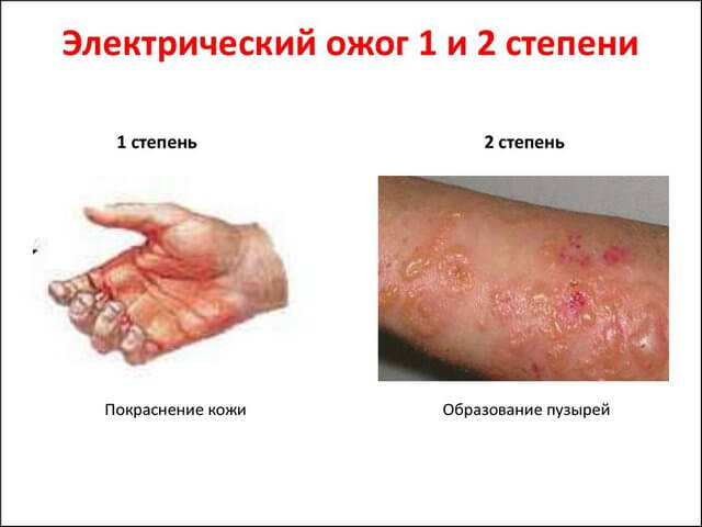 Повреждения кожи от удара током