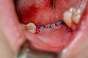  уход за полостью рта после удаления зуба