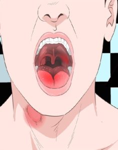 Чем лечить ожог горла,Особенности лечения
