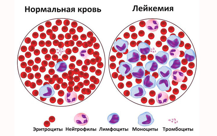 Заболевания крови могут носить и онкологический характер