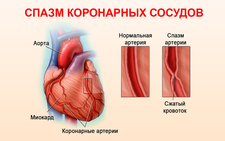 Спазм коронарных артерий