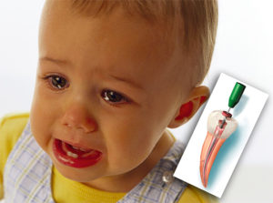 лечение пульпита молочных зубов у детей