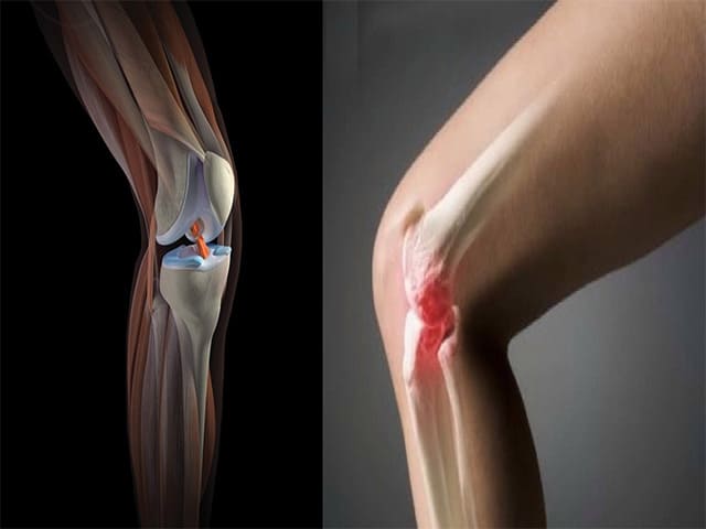 Крестообразная связка коленного сустава: травмы, лечение, реабилитация