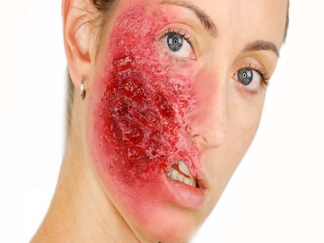 Повреждение кожи лица