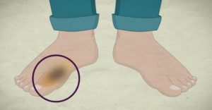 Что делать при переломе пальца на ноге