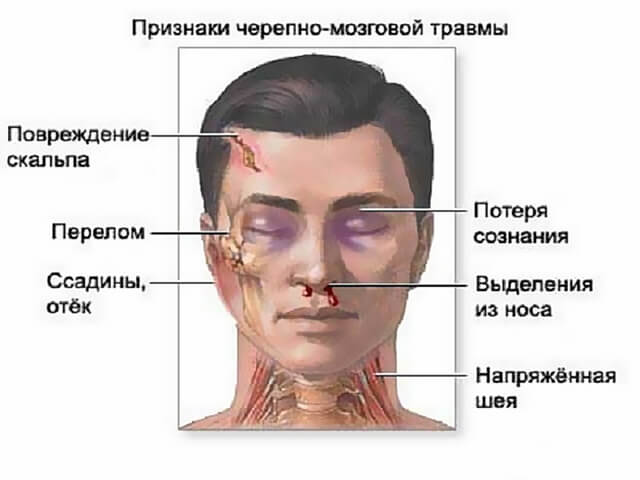 Симптомы ушиба мозга