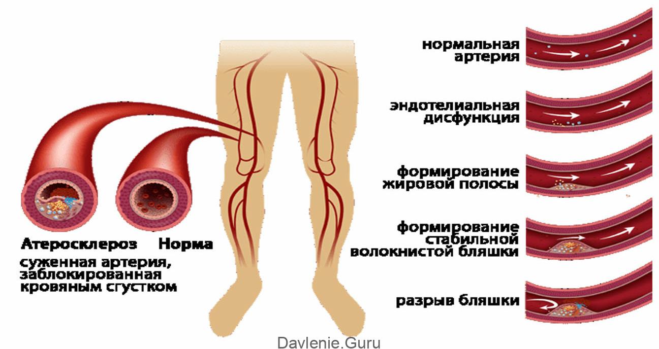 Атеросклеротическое поражение нижних конечностей