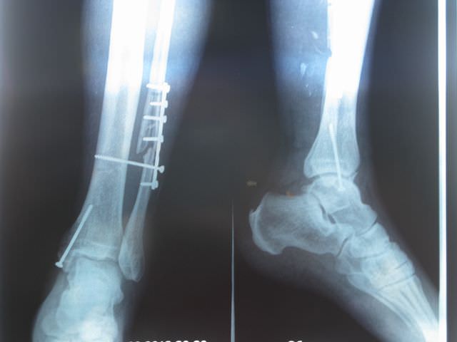 Рентген перелома ноги