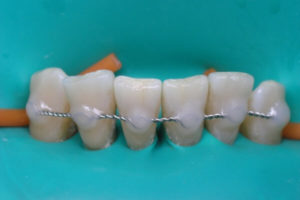 Как проводится шинирование зубов при пародонтите