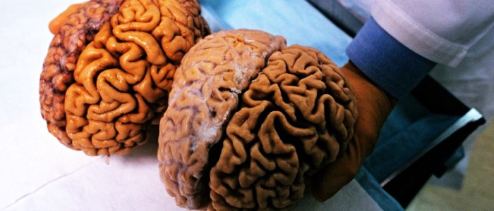 Мозг пострадавшего