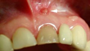 лечение радикулярной кисты зуба верхней челюсти