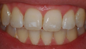 Почему появляются черные точки на зубах и способы избавления от них