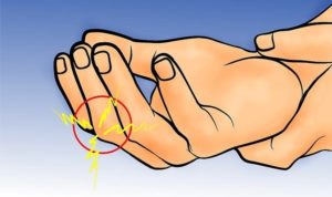 Признаки и лечение перелома пальца на руке