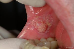Как лечится рак слизистой оболочки полости рта 