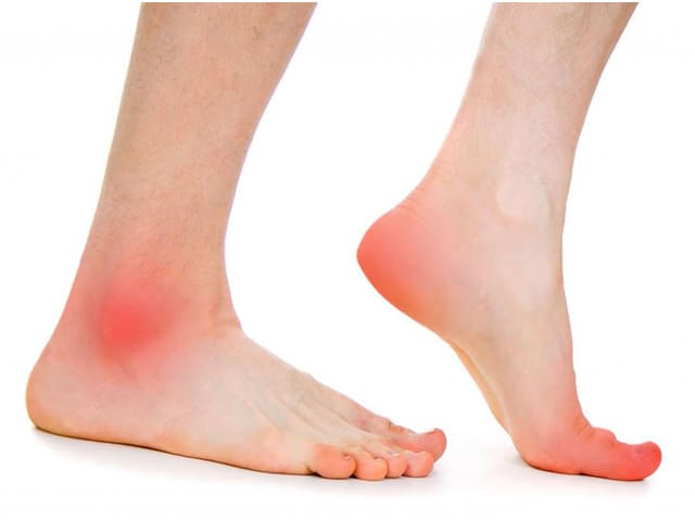 Как проявляется артрит стопы и как его лечить?
