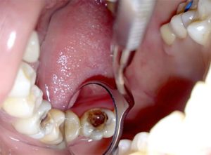 Зачем кладут мышьяк в зуб и сколько его можно держать