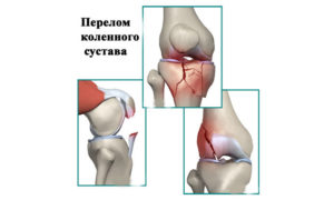 Перелом коленного сустава