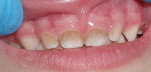 Почему появляется коричневый налет на зубах и способы избавления от него