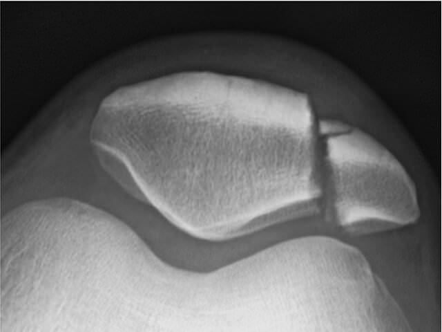 Рентгеновский снимок ноги
