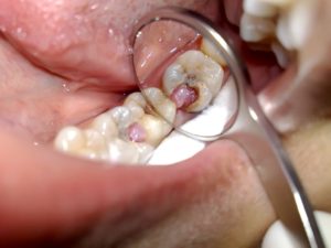 Основные симптомы и лечение острого пульпита зуба