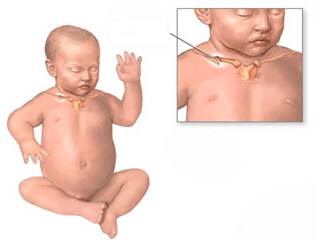 Перелом ключицы у новорожденных при родах