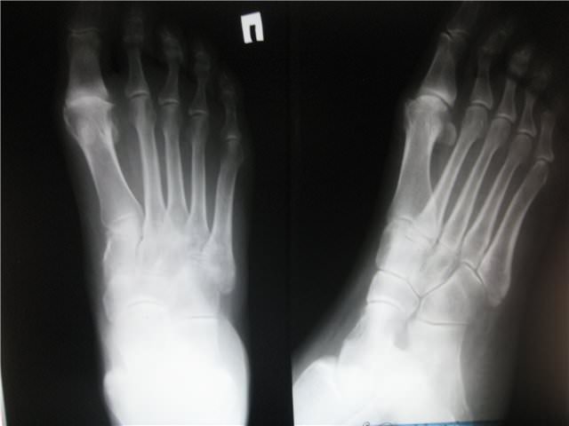 Рентген снимок перелома ножных костей