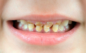 Лечение перелома зуба в домашних условиях 