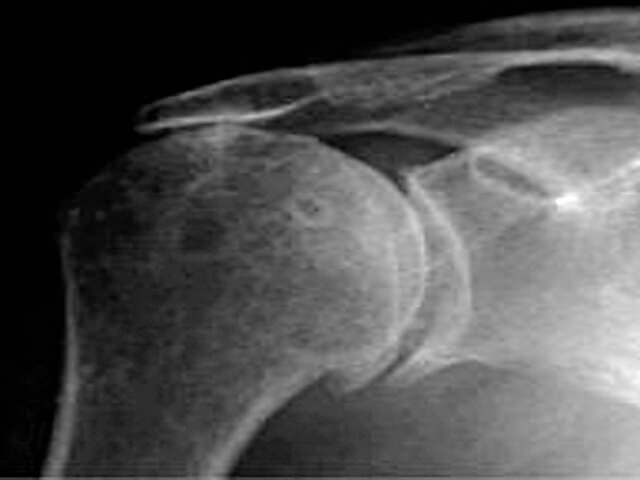 Рентгеновский снимок плеча