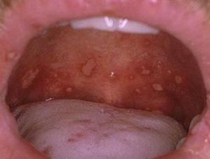 сыпь на слизистой полости рта и лечение