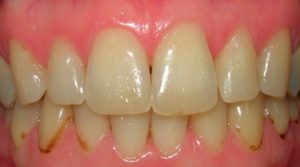 Почему появляются черные пятна на зубах 