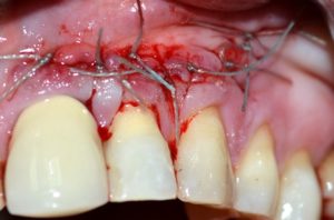 Как проводится цистэктомия зуба