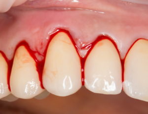 Как лечить, если кровоточит десна между зубами