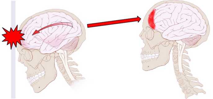 Ушиб головного мозга человека