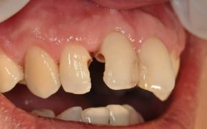 Почему появляется кариес между зубами