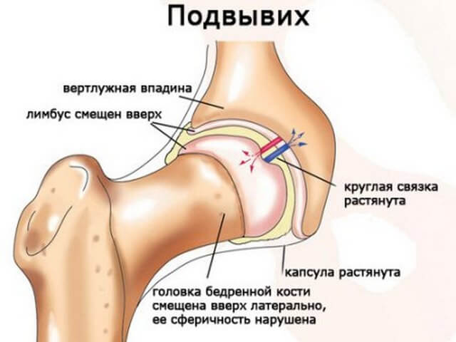 Травма бедра