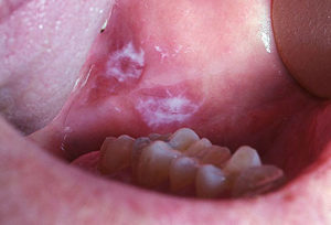 Как лечится рак слизистой оболочки полости рта и последствия