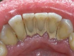 Как проводится удаление налета на зубах в домашних условиях