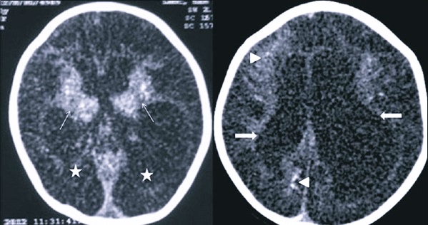 Нсг мозга. Нейросонография при гидроцефалии. Нейросонография кровоизлияние УЗИ. Нейросонография головного мозга новорожденных. Ватолина нейросонография.