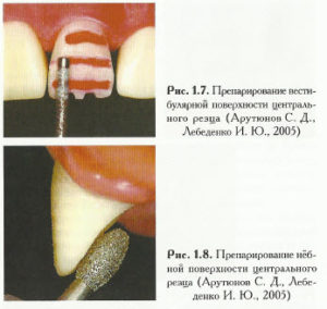 Как проводится препарирование зуба под металлокерамическую коронку и зачем оно нужно