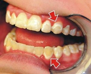 коричневый налет на зубах и способы избавления от него