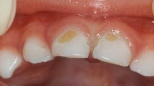 Что вызывает появление черных пятен на зубах