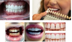  ставят виниры на зубы в стоматологии