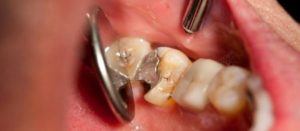 Мышьяк в стоматологии – показания и противопоказания