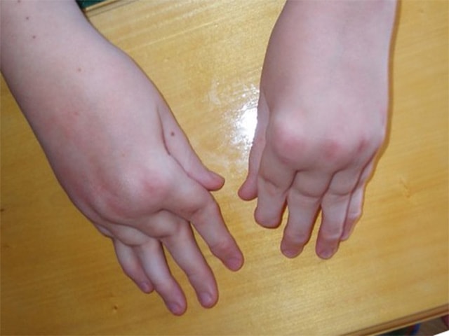 Симптомы и методы лечения ревматоидного артрита пальцев рук