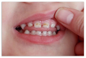 Лечение перелома зуба в домашних условиях 