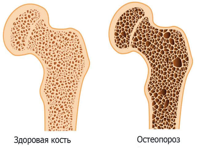 Остеодистрофия