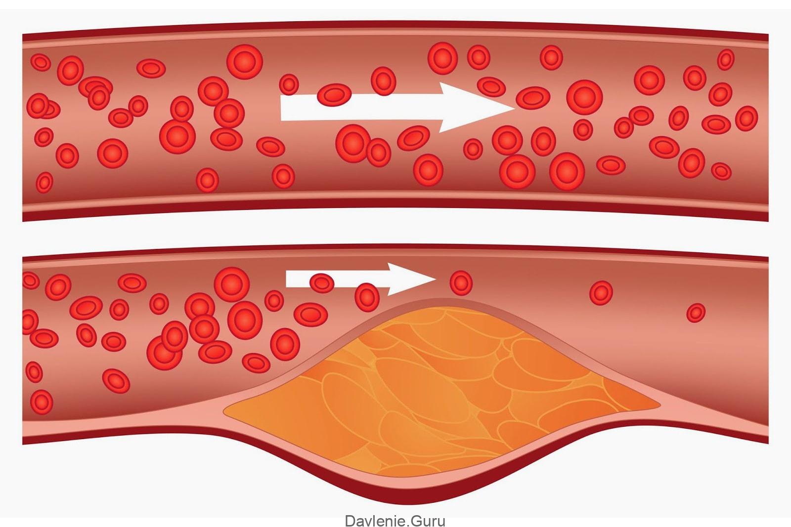 Очищение кровеносного русла от холестериновых бляшек