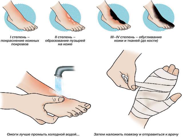 Схема оказания первой помощи при термическом повреждении кожи