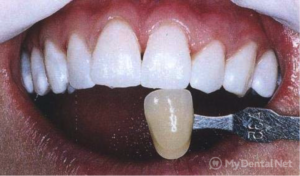  химическое отбеливание зубов