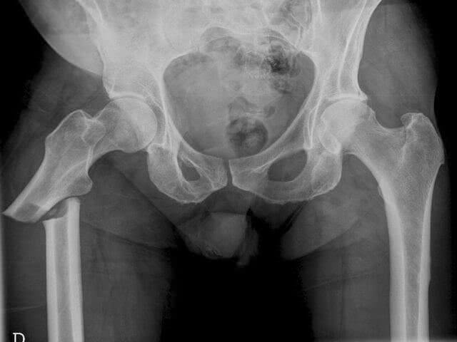 Рентгеновский снимок бедра